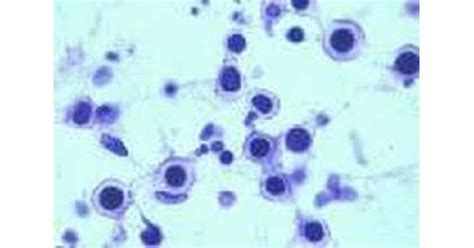 Cryptococcus Neoformans Gram Stain