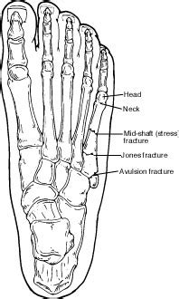 Fifth Metatarsal Fracture - Broken 5th Metatarsal | Foot Health Facts ...