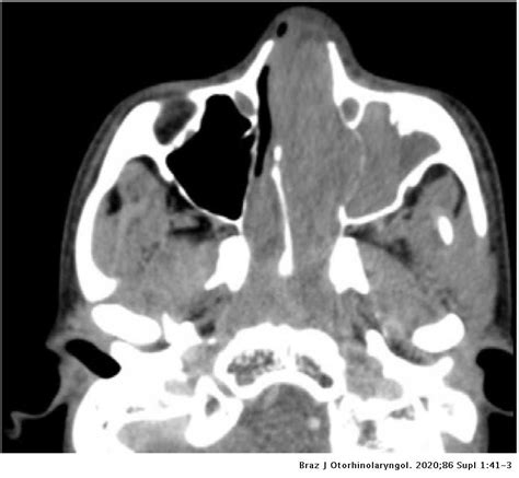 Peripheral neuroectodermal tumor in the nasal cavity – a case report ...