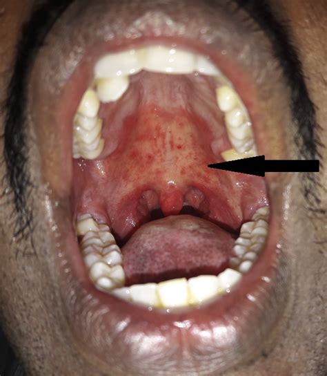 Erythematous Candidiasis - The Journal of Allergy and Clinical ...