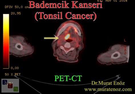 Tonsil Cancer - Causes, Symptoms, Diagnosis and Treatment