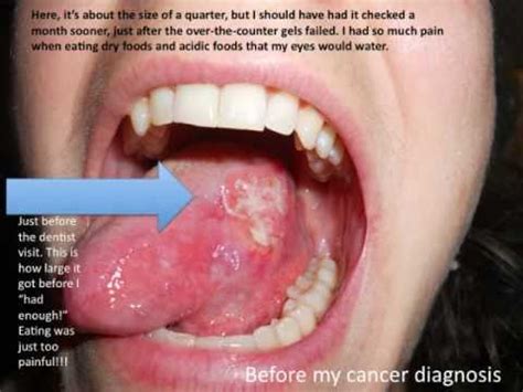 Neoplasm: Neoplasm Tongue