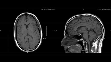 Normal Brain Mri With Contrast Images Radiologia