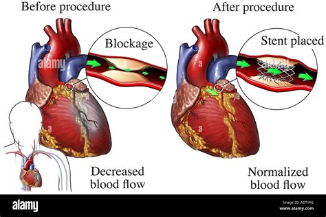 Coronary Artery Stent Placement