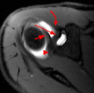 MRI Musculo-Skeletal Section: Glenohumeral ligaments