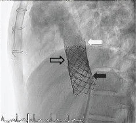 A second bare stent was then applied over the overlapping section of ...