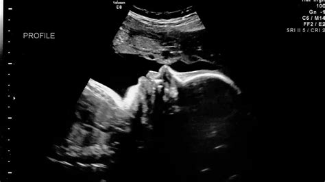 How Does an Ultrasound Produce an Image of a Fetus in the Mother’s Uterus?