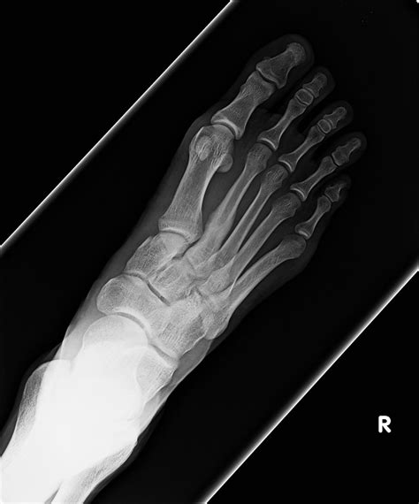 2nd metatarsal stress fracture top view | This is the x-ray … | Flickr