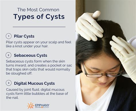 Epidermoid Cyst Scalp