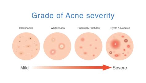 What Causes Cystic Acne And How To Treat It Effectively | SL Aesthetic ...