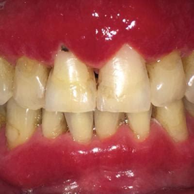 Severe Gingival Swelling and Erythema | MDedge Dermatology