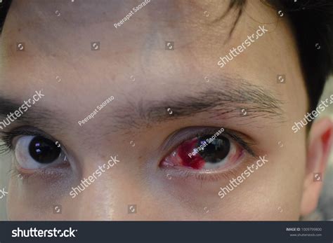 Eye Bleeding Conjunctiva Hemorrhage Human Stock Photo 1009799800 ...