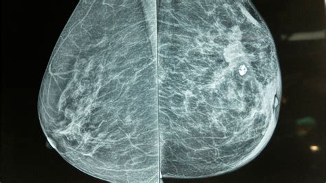 Mammogram for stage 1 breast cancer