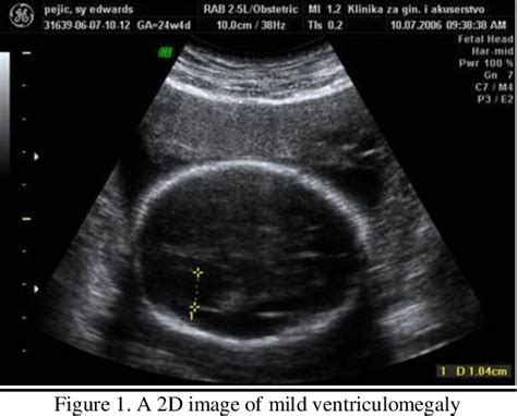 Trisomy 18 Ultrasound