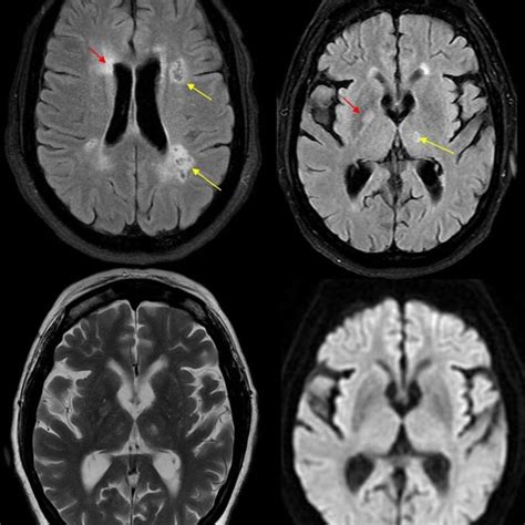 Diffuse brain atrophy in a hypertensive patient. Axial T2WI shows ...