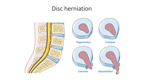 Surgery for a slipped disc | General center | SteadyHealth.com