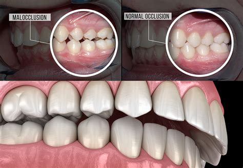 Overbite and Underbite Treatment in Los Angeles, CA - Misaligned teeth ...