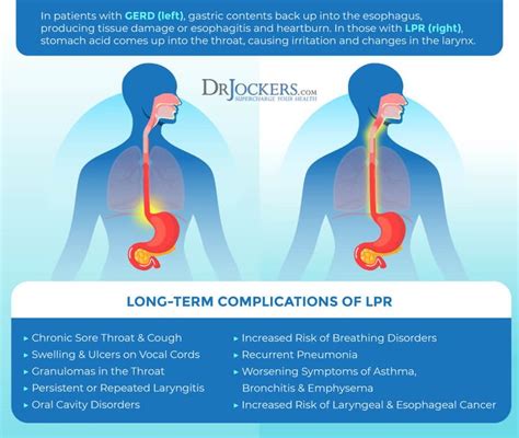 Silent Reflux: Symptoms, Causes, and Support Strategies | Silent reflux ...