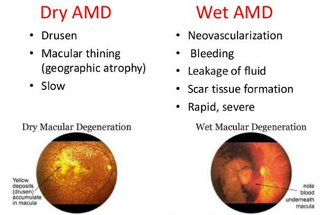 Macular Degeneration | AMD | Causes and Treatment | EyeMantra