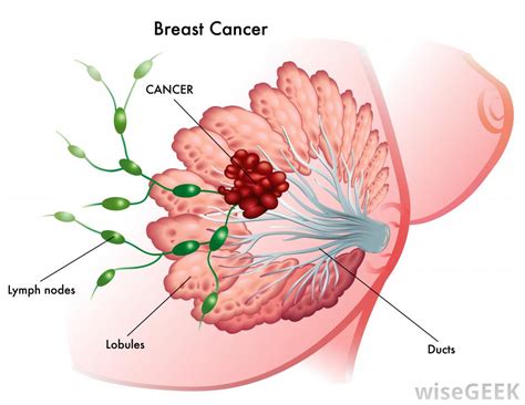 Breast Cancer: 5 Ways to Reduce Your Risk - PeopleBeatingCancer