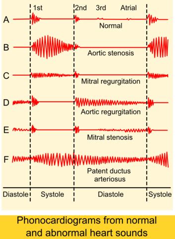 Heart Sounds – Origin, Timing and Murmurs | Medical Library