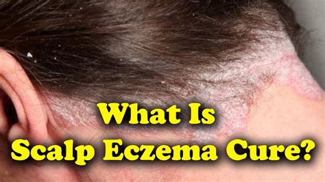 Homemade Remes For Scalp Eczema - Homemade Ftempo