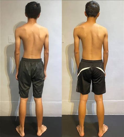 Incredible Scoliosis Results — Functional Patterns Brisbane