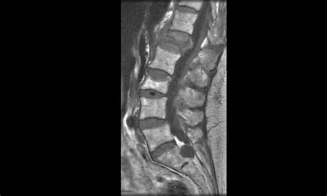 Bone Density Scan (DXA or DEXA) | UCSF Radiology