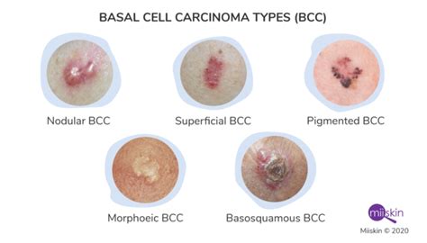 Skin Cancer - Types, Symptoms, Causes and Prevention