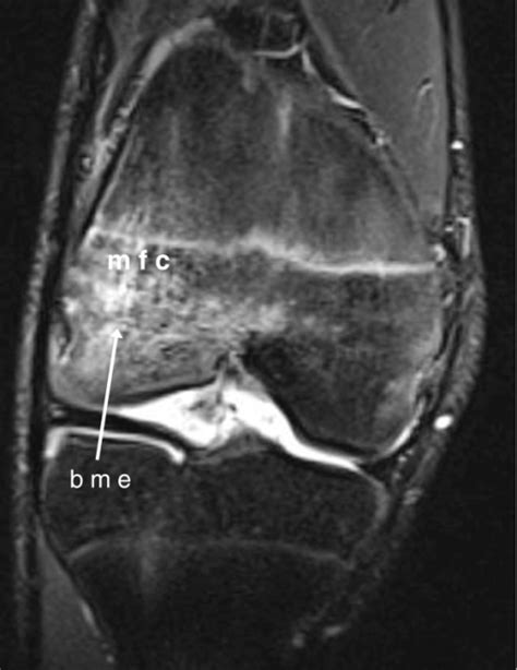 Imaging of the symptomatic knee of a 14-year-old boy wi | Open-i