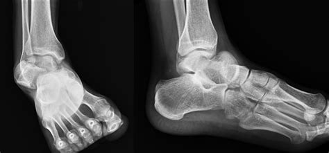 Subtalar dislocation | The Foot and Ankle Online Journal