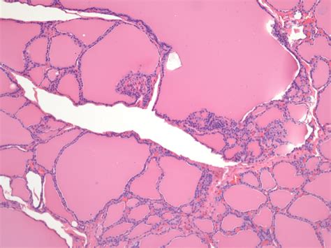 Multinodular Goiter Histology