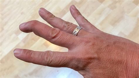 Mallet Finger: Causes, Symptoms, and Treatment