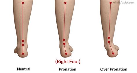 The Three Kinds of Foot Strikes: Pronation, Supination, and Neutral ...