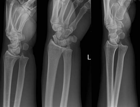 Distal Radioulnar Injury • LITFL • Clinical Cases Bamboozler