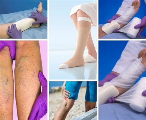 Guide To Venous Leg Ulcers - Vein Solutions