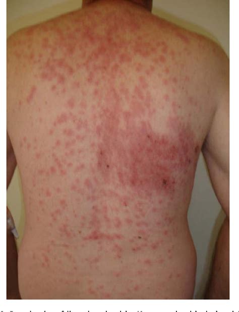 Figure 2 from A rare case of disseminated shingles in an ...