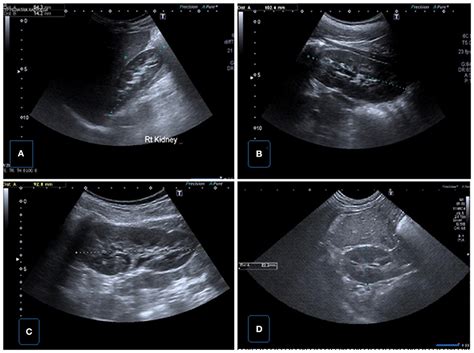 Kidney Stone Ultrasound