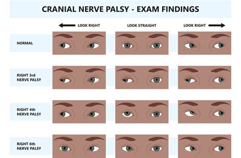 Trochlear Nerve Palsy Eye Position