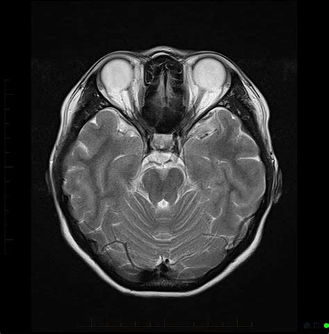 Mri Scans Brain