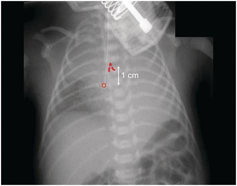 Endotracheal Tube Placement X Ray