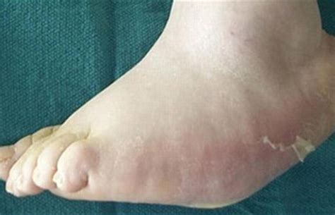 Diabetic Charcot Foot – Columbus Foot and Ankle