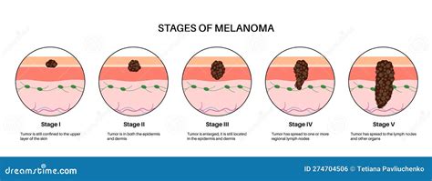 Melanoma Skin Cancer Stages