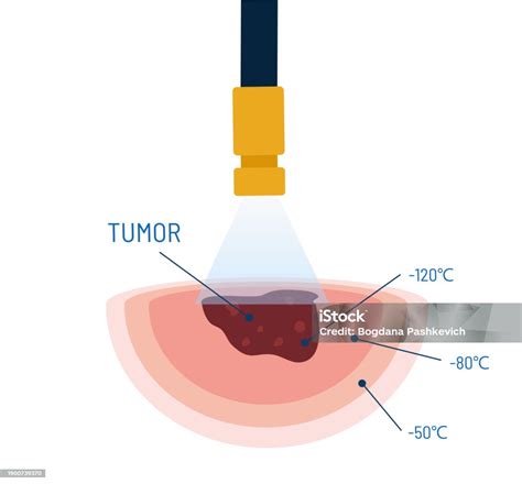 Cryosurgery Procedure Vector Illustration Medical Instrument With ...