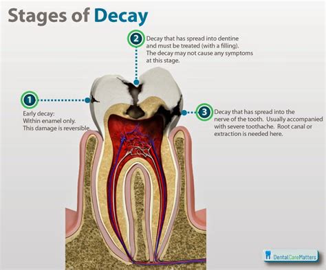 Pediatric Dentist, Bangalore: Root Canal Treatment for Baby Teeth ...