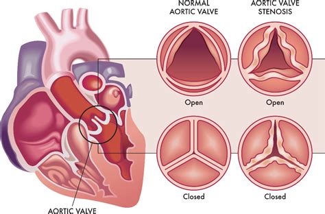 What are Aortic Stenosis Symptoms and Causes? | Dr. C Raghu