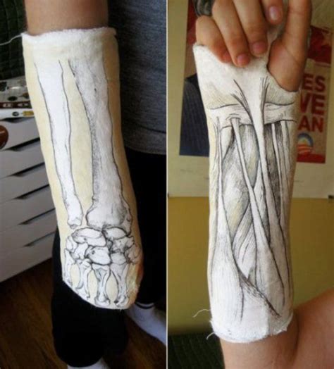 Awesome – theCHIVE | Cast art, Broken hand cast, Arm cast