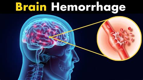 What Happens in Brain hemorrhage? | Symptoms, Causes and Treatment (3d ...