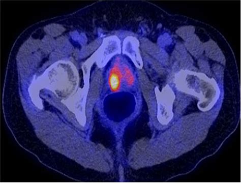 Prostate Cancer: PET with 18F-FDG, 18F- or 11C-Acetate, and 18F- or 11C ...