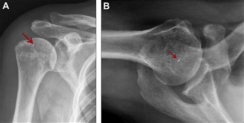 The plain anteroposterior (A) and axial (B) radiograph of the shoulder ...